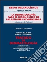 Nevos melanocíticos-La dermoscopía para el diagnóstico de las lesiones pigmentadas. Capítulo 87 extraído de Tratado de dermatología. E-book. Formato EPUB ebook