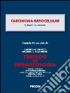 Carcinoma basocelular. Capítulo 92 extraído de Tratado de dermatología. E-book. Formato EPUB ebook di C. Crosti