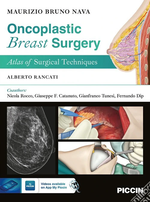 Oncoplastic breast surgery. Atlas of surgical techniques