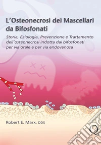 L'osteonecrosi dei mascellari da bifosfonati