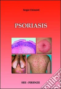Psoriasis