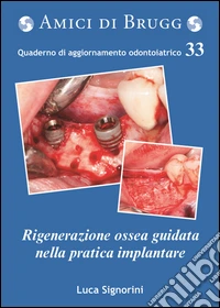 La rigenerazione ossea guidata nella pratica implantare libro