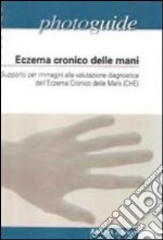 Eczema cronico delle mani. Supporto per immagini alla valutazione diagnostica dell'eczema cronico delle mani